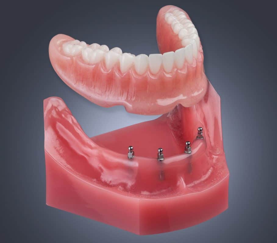 Implant Supported Removable Dentures - Implant Dentures