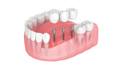 Multiple Tooth Replacement - Implant Bridge