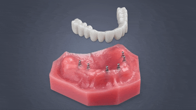 Mini Dentures in Harrisburg, NC | Dental Implants | Dr. David Ney