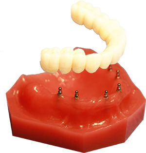 All-on-4 Alternatives in Harrisburg, NC | Fix-on-Six Dentures